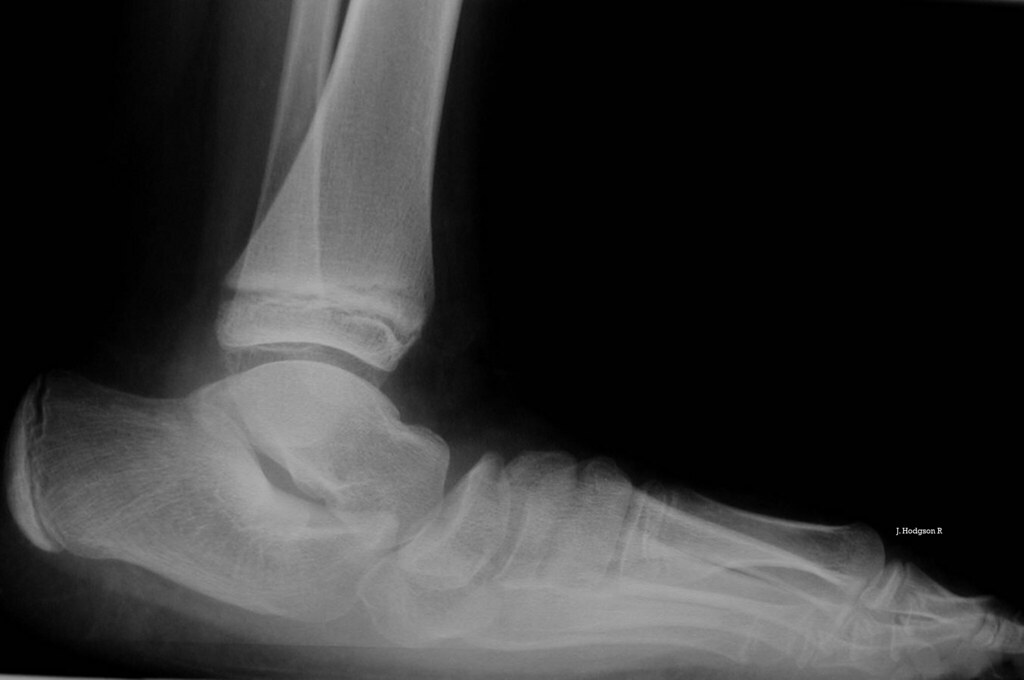 PIE PLANO VALGO Pie plano valgo grado IV. Varón de 13 años… Flickr