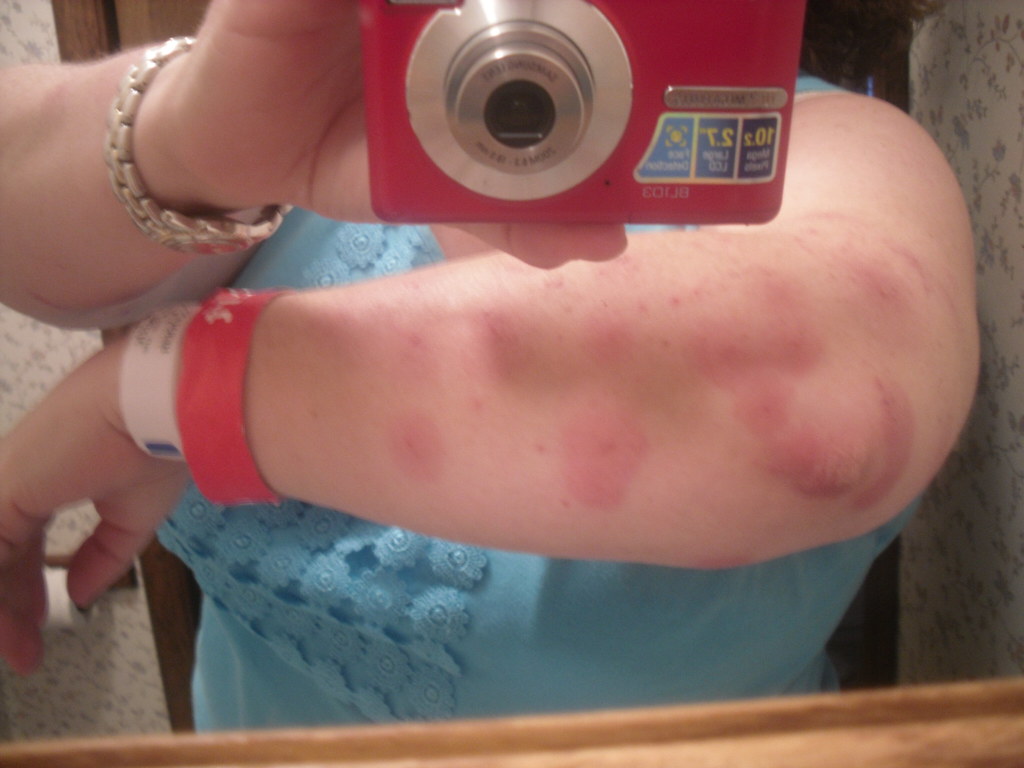 Bedbug bites (before infection) janielianne Flickr