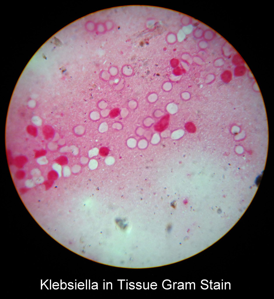 Klebsiella in Tissue Gram Stain a photo on Flickriver