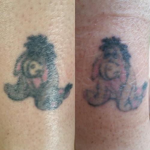 Documenting my tattoo removal. The right shows my leg afte… Flickr