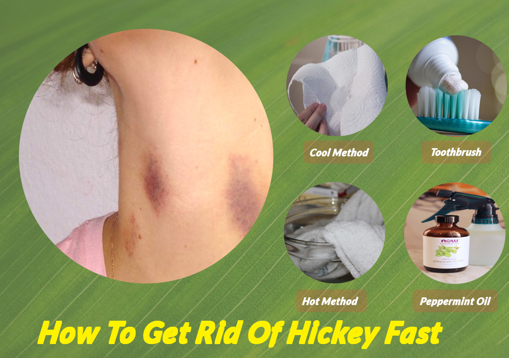 Whisk Method To Get Rid Of Hickeys at Lisa Post blog
