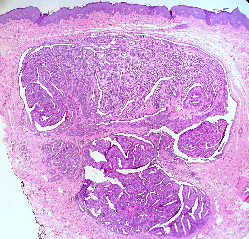 Hidradenoma Papilliferum of the Vulva Punch biopsy from a … Flickr