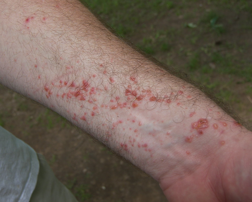 John's poison ivy rash His legs are covered, too. For that… Flickr