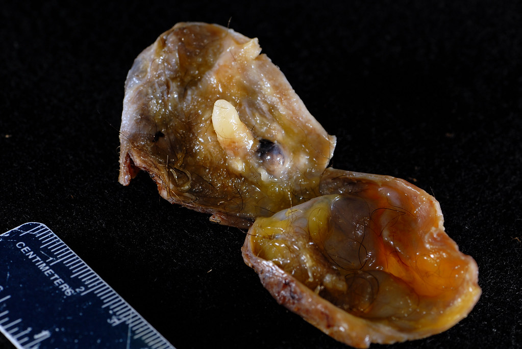 Dermoid cyst with tooth A tooth was identified in the