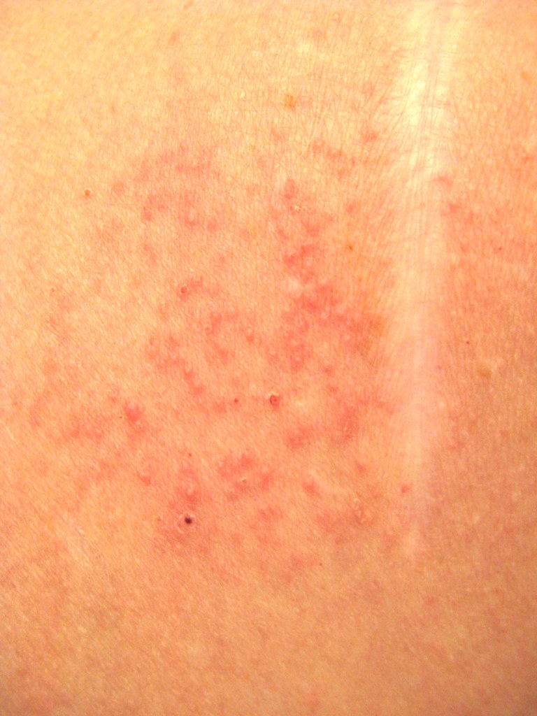 Rash on My Shoulder from the Sleep Apnea Study Connectors Flickr