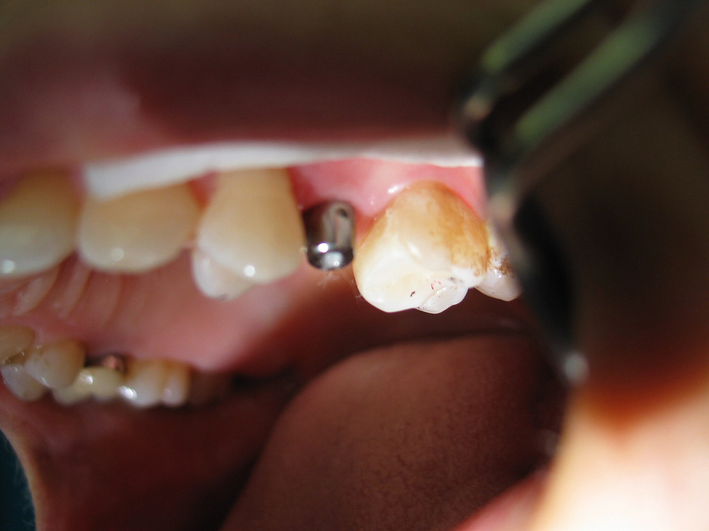 boiseidahodenturesanddentalservices European Denture … Flickr