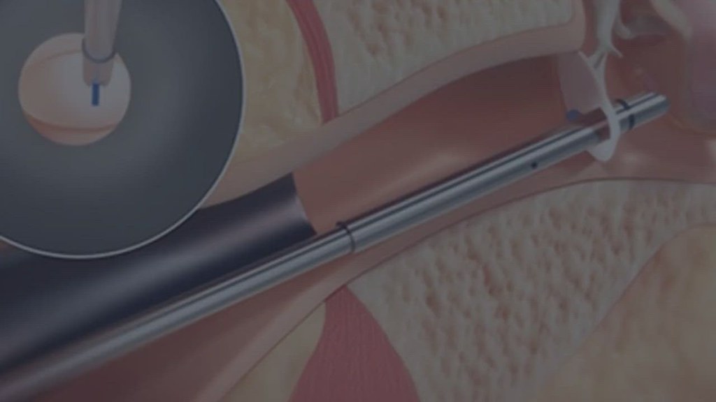 Product Tympanostomy products, such as tympanostomy tubes,… Flickr