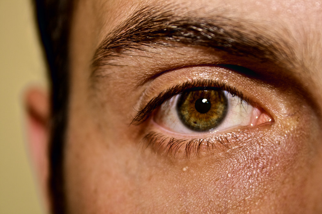 Can Eye Freckles Disappear at Sherry Witherspoon blog