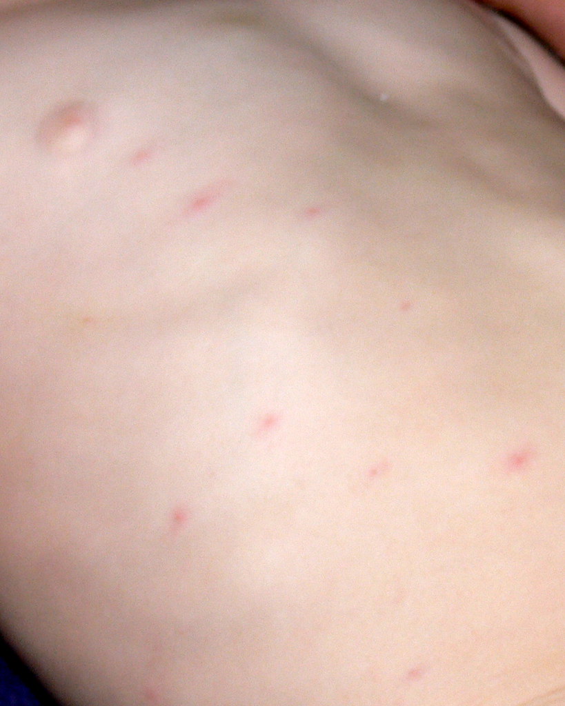 Viral rash a photo on Flickriver