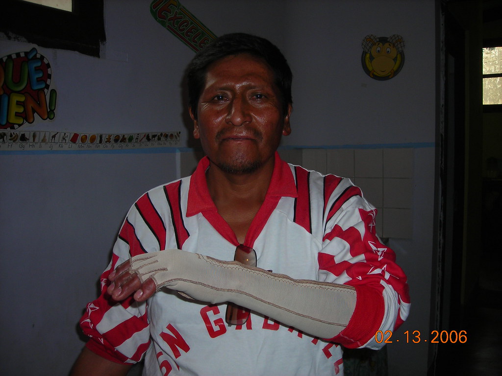 An electrical burn Burn Care International Flickr