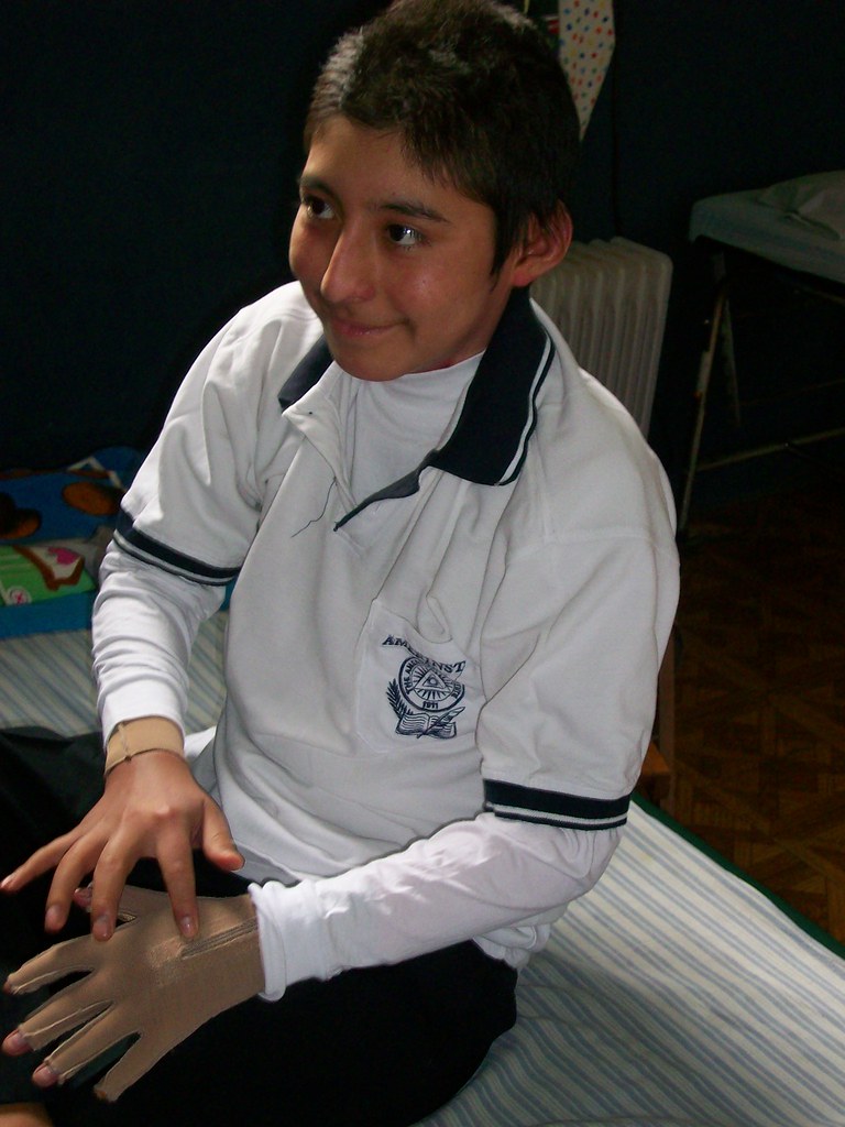 BCI July 2008 375 Burn Care International Flickr