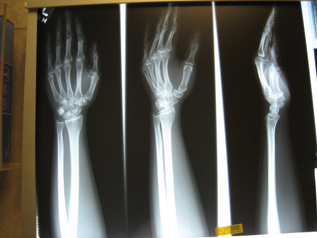my sexy, sexy bones My xrays at the orthopedist's office … Flickr