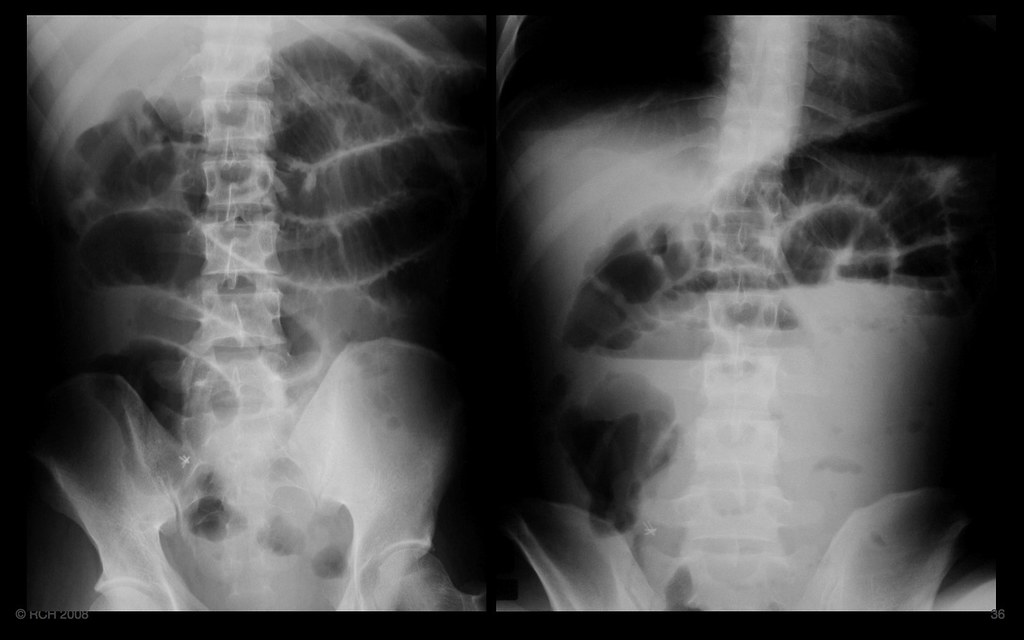 Small bowel obstruction, typical example, AXR a photo on Flickriver