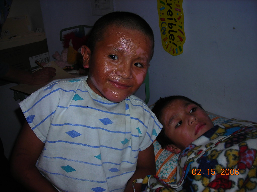 Two little burned friends Burn Care International Flickr