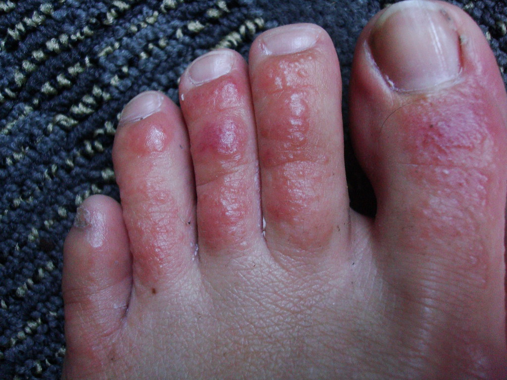 365 2 Day 79 / Getting Better? Day 4 of this horrible foot… Flickr