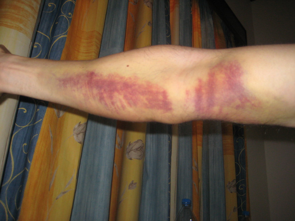 All sizes bruise after giving blood (a week later) Flickr Photo
