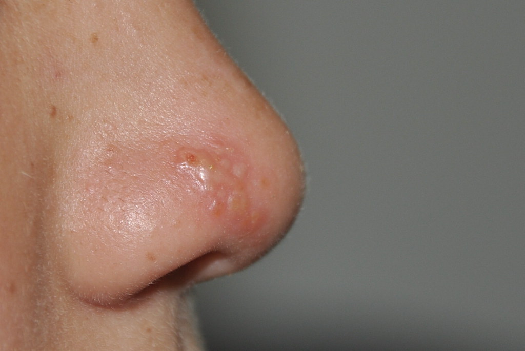 Herpes simples nasal Gilberto M Palma Flickr