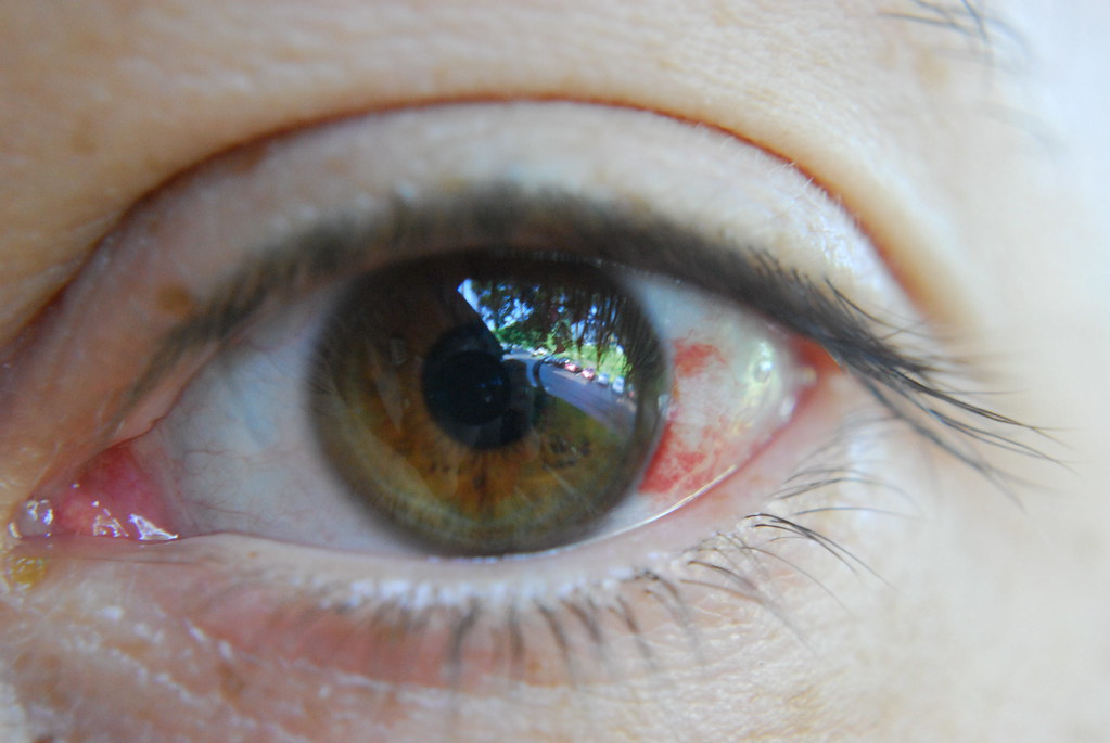 Eye Hemorrhage Eye Hemorrhage Day 3 4 Days of the Healing … Flickr