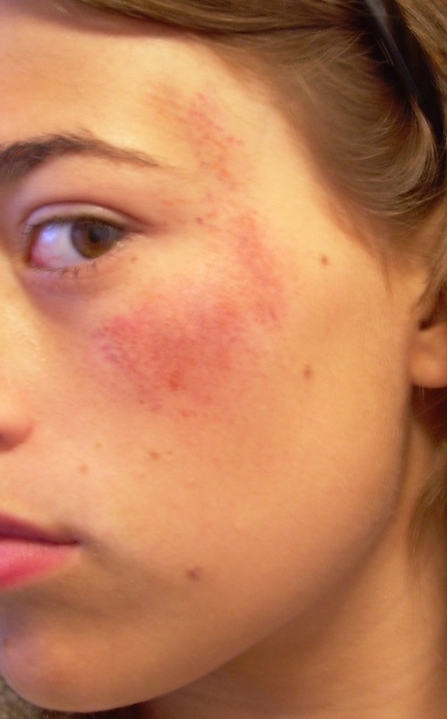 bruising this is a rug burn/bruise made it by putting purp… Flickr