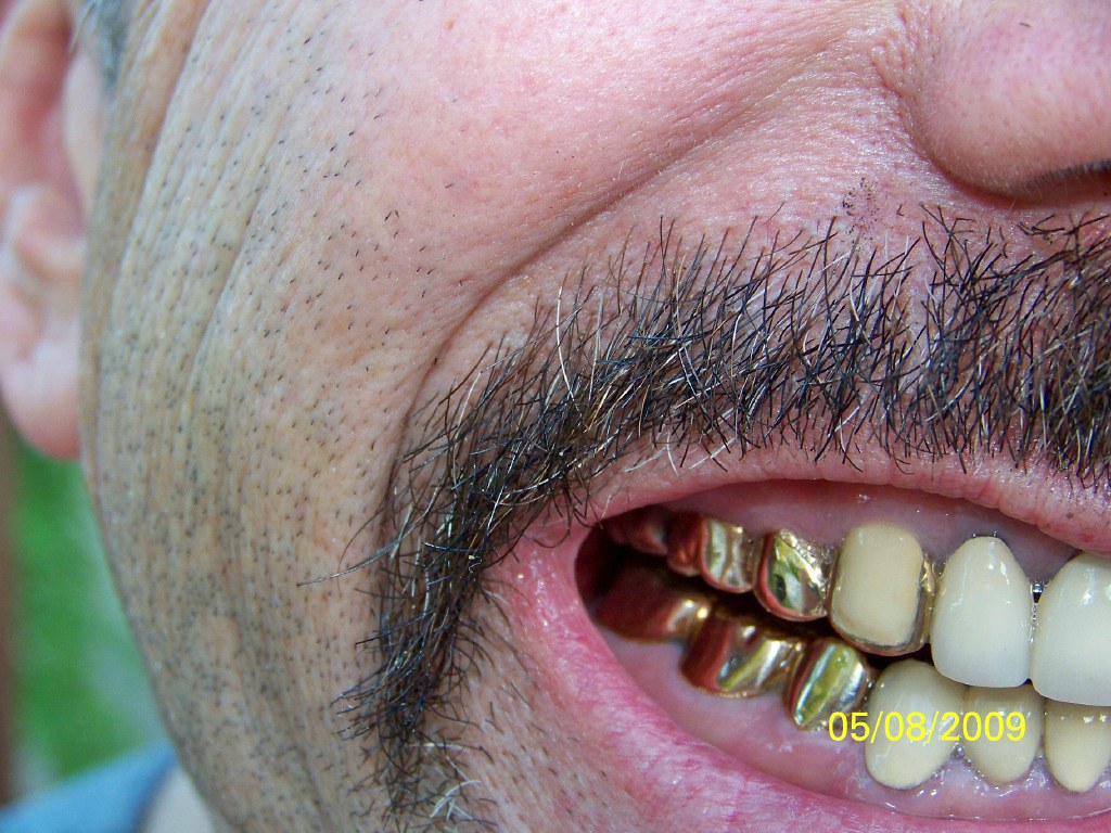 GOLD CROWNS RIGHT VIEW Gold Teeth Rt Side glennmopar Flickr