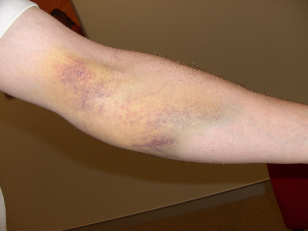 Joint Haematoma maternity photos