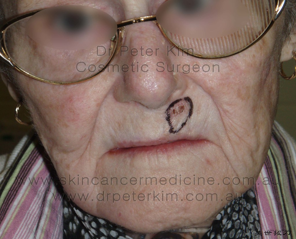 BCC LIP 1 Basal Cell Carcinoma of the left upper lip. dr.peterkim