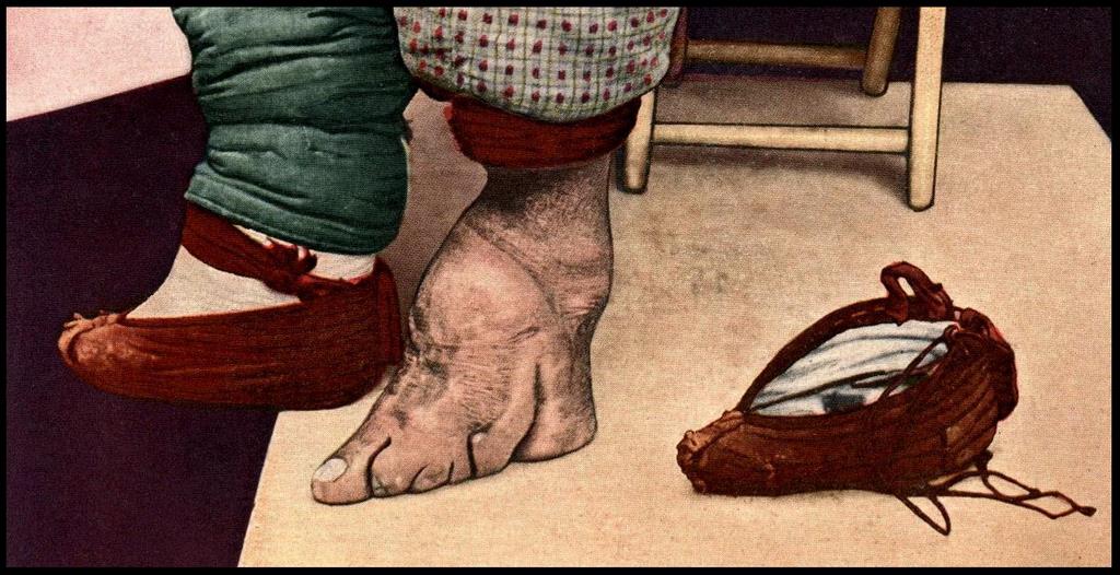 CHINESE FOOT BINDING (5) to CHINESE FOOT BINDING 1… Flickr
