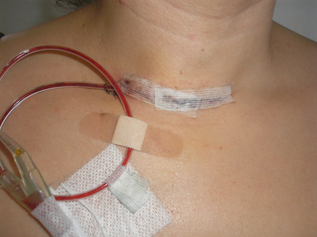 Drain Pain The tube that is visible on the outside measure… Flickr