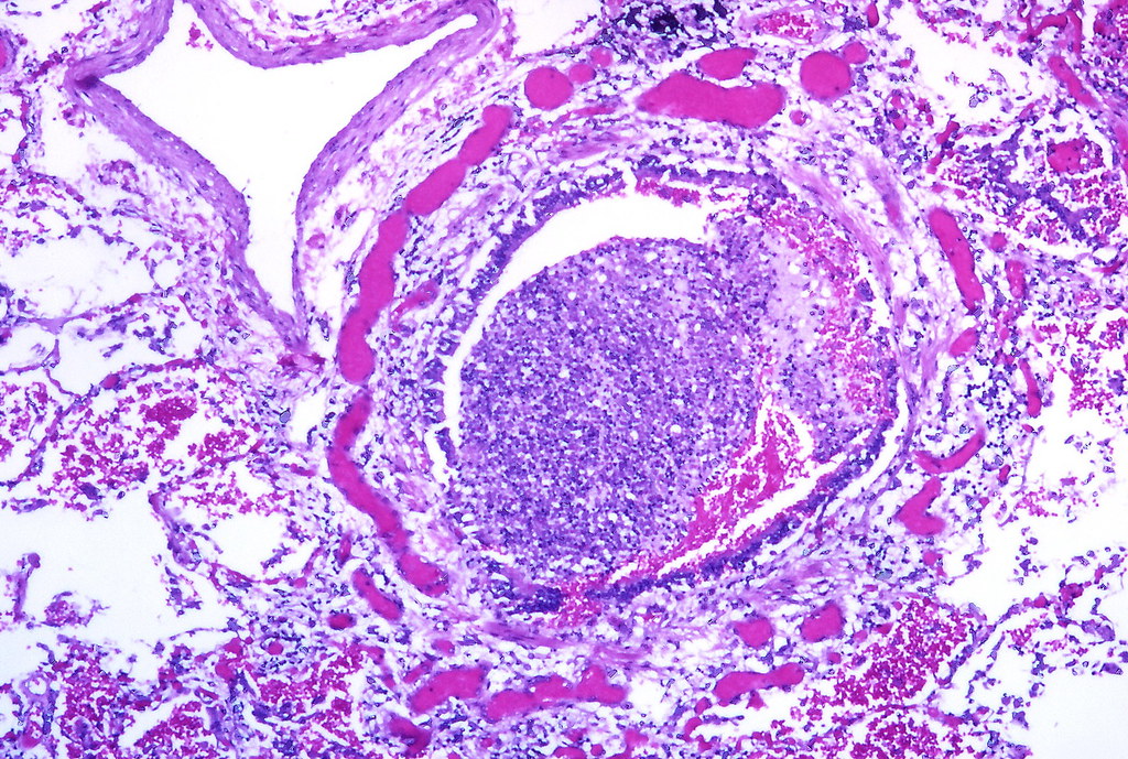 Bronchopneumonia, early Acute bronchiolitis with mild acut… Flickr