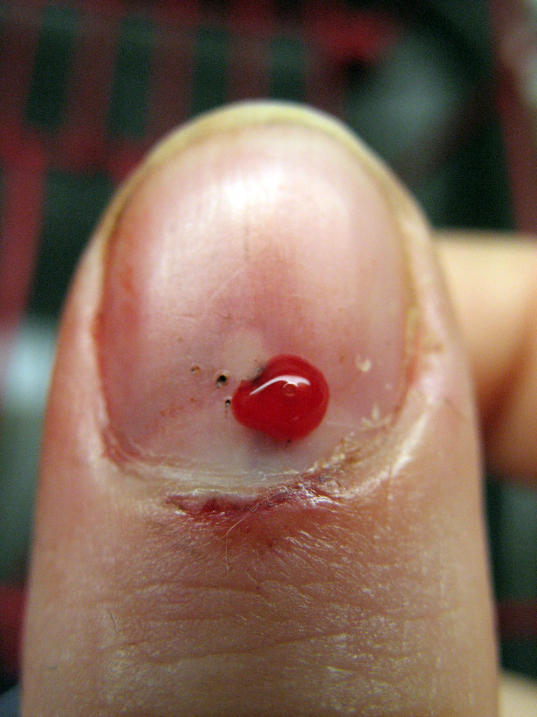 How to Fix a Subungal Hematoma Part 3 of 4 When the need… Flickr