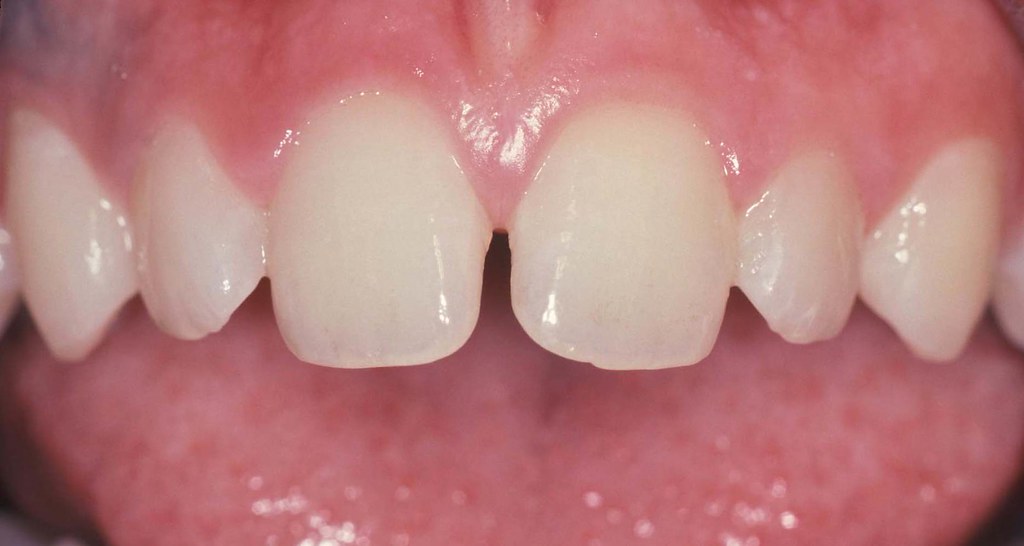 Upper Midline Dental Diastema & Upper Labial Fraenum Flickr