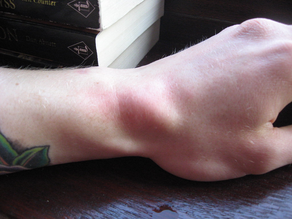 32 19/04/09 Sprain Sprained my wrist skateboarding. Ou… Flickr