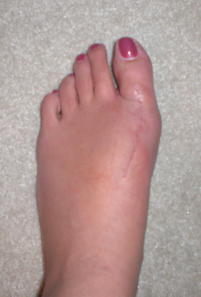 After Bunion Surgery 9 weeks Healing nicely, but still a w… Flickr