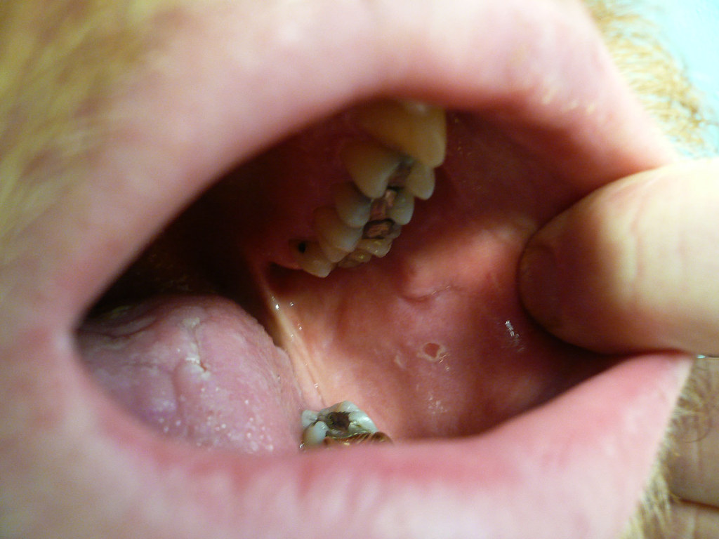 mouth sores These are the lesions on the sides of my mouth… Flickr