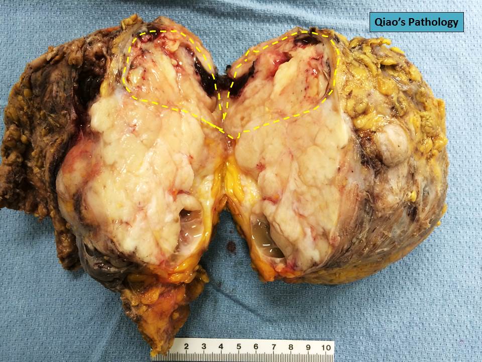 Qiao's Pathology Phyllodes Tumor of the Breast with Sarco… Flickr