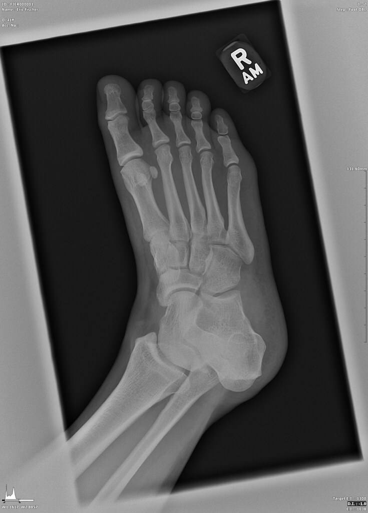 Xray of my right foot Not broken, just swollen. Flickr