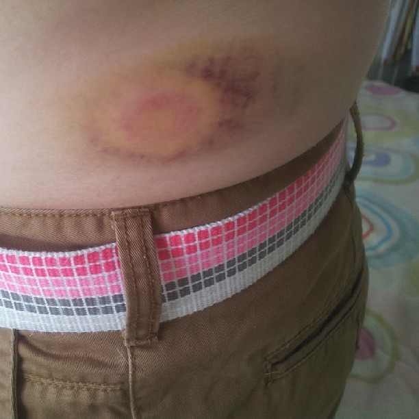 Paintball injury two days on. Every day a new colour. nof… Flickr