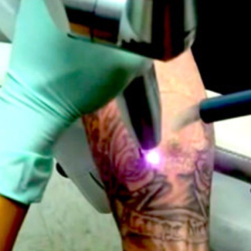 Cuidados Depois de Fazer Tatuagem Beleza Cultura Mix Saiba dos cuidados antes e após remoção de tatuagem ! http… Flickr