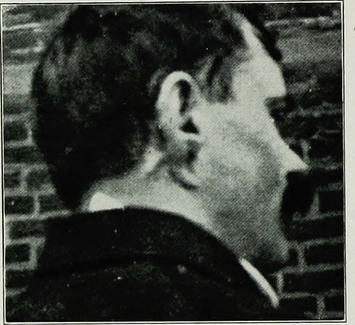 Image from page 395 of "War surgery of the face. A treatis… Flickr