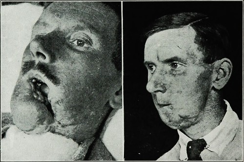 Image from page 251 of "War surgery of the face. A treatis… Flickr