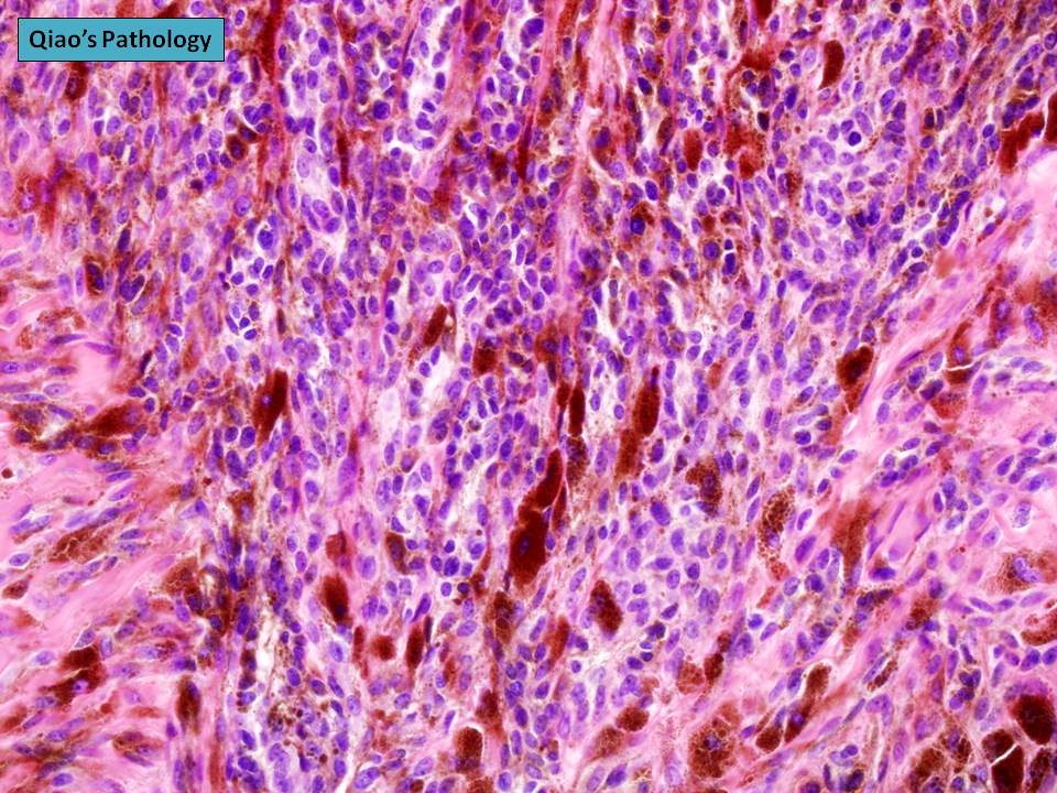 Qiao's Pathology Cellular Blue Nevus Microscopic photo sh… Flickr