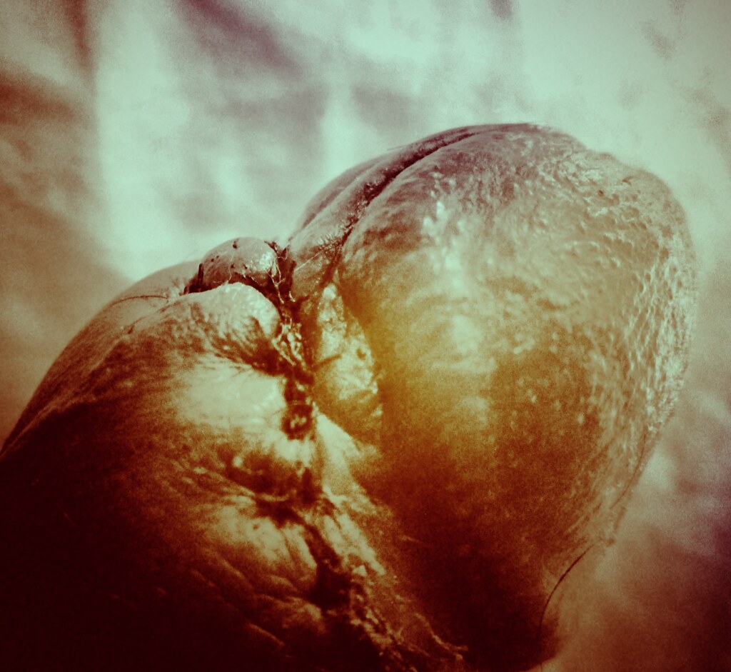 5 days after circumcision DICKENSTEIN Flickr