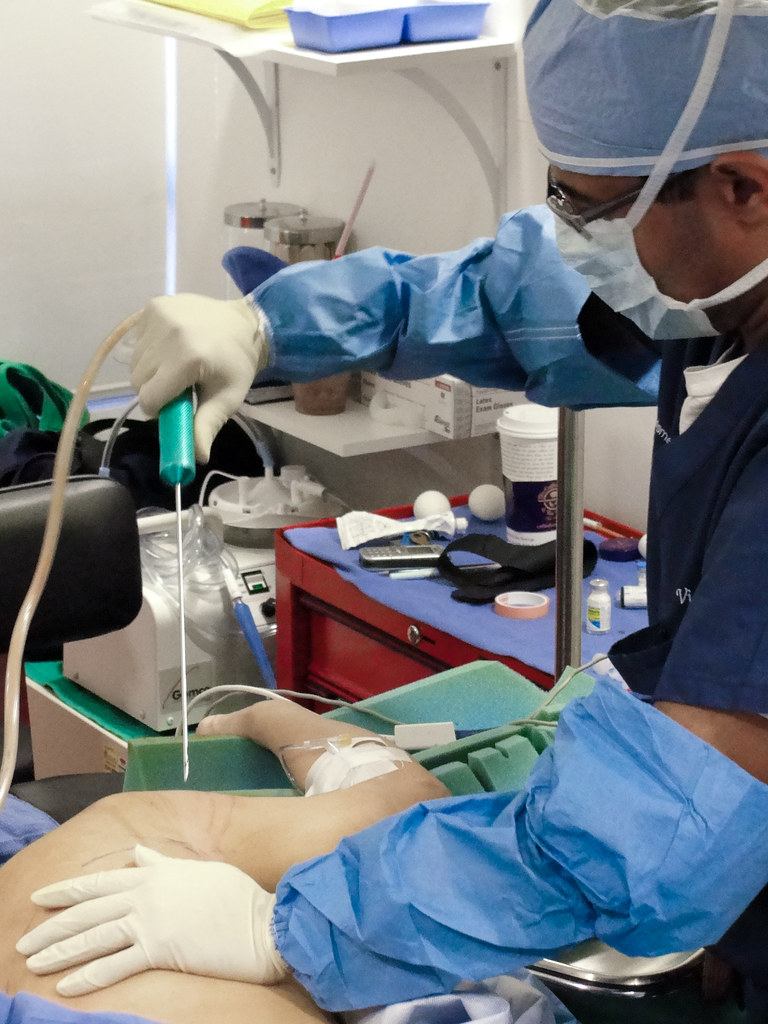 Los Angeles Liposuction Surgery, What is Liposuction Dr. V… Flickr