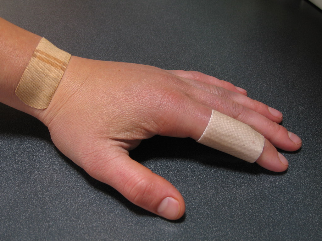 IMG_2976 One week after surgery, swelling is starting to g… Flickr