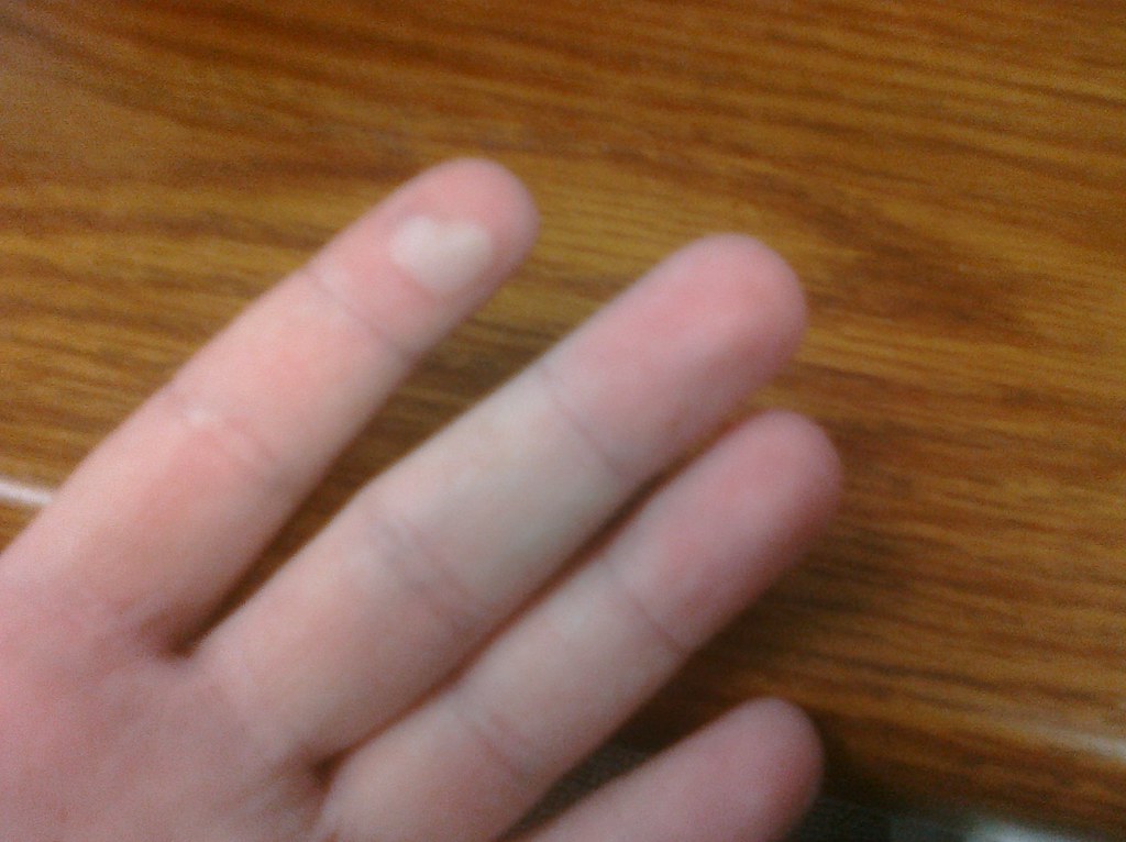 Ptw Burned my finger on stove the other day. Blister in sh… Flickr