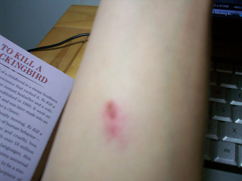 Airsoft Wound I was playing with my team on Saturday, 22 M… Flickr