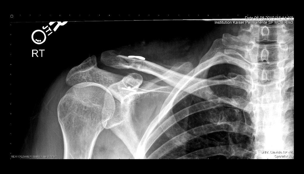 Clavicle Post Surgery Xray After getting the staples out. … Flickr