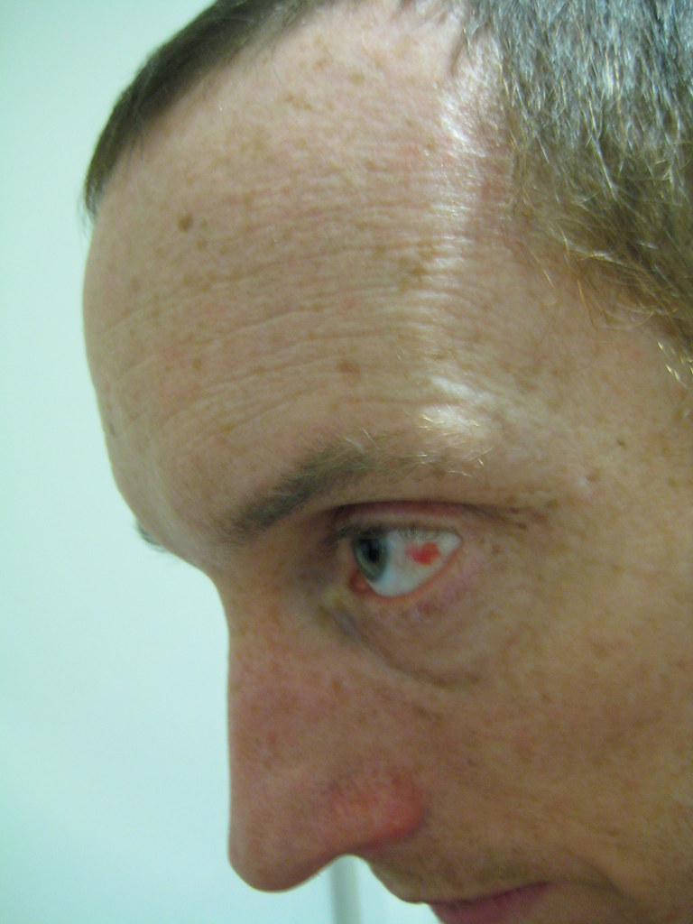 Paper cut to the eye! Mark Oldfield Flickr