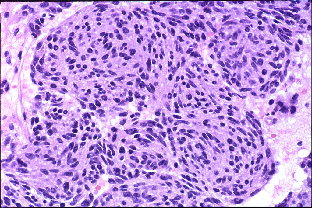Typical carcinoid, spindle cell type Dr. Yale Rosen Atlas of
