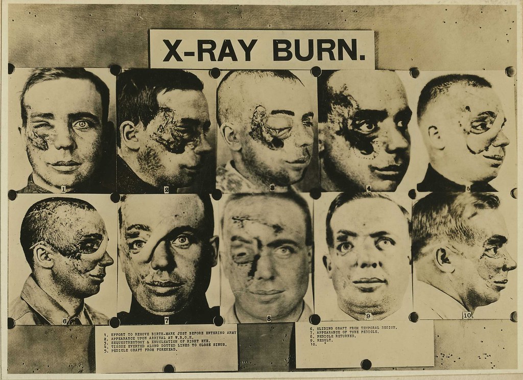 Xray burns of face (Reeve 44043), National Museum of Heal… Flickr